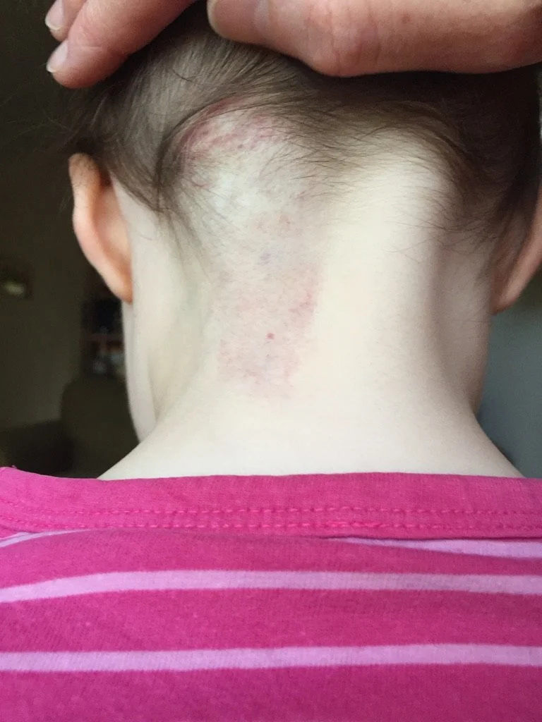 infantile-hemangioma-back.jpeg