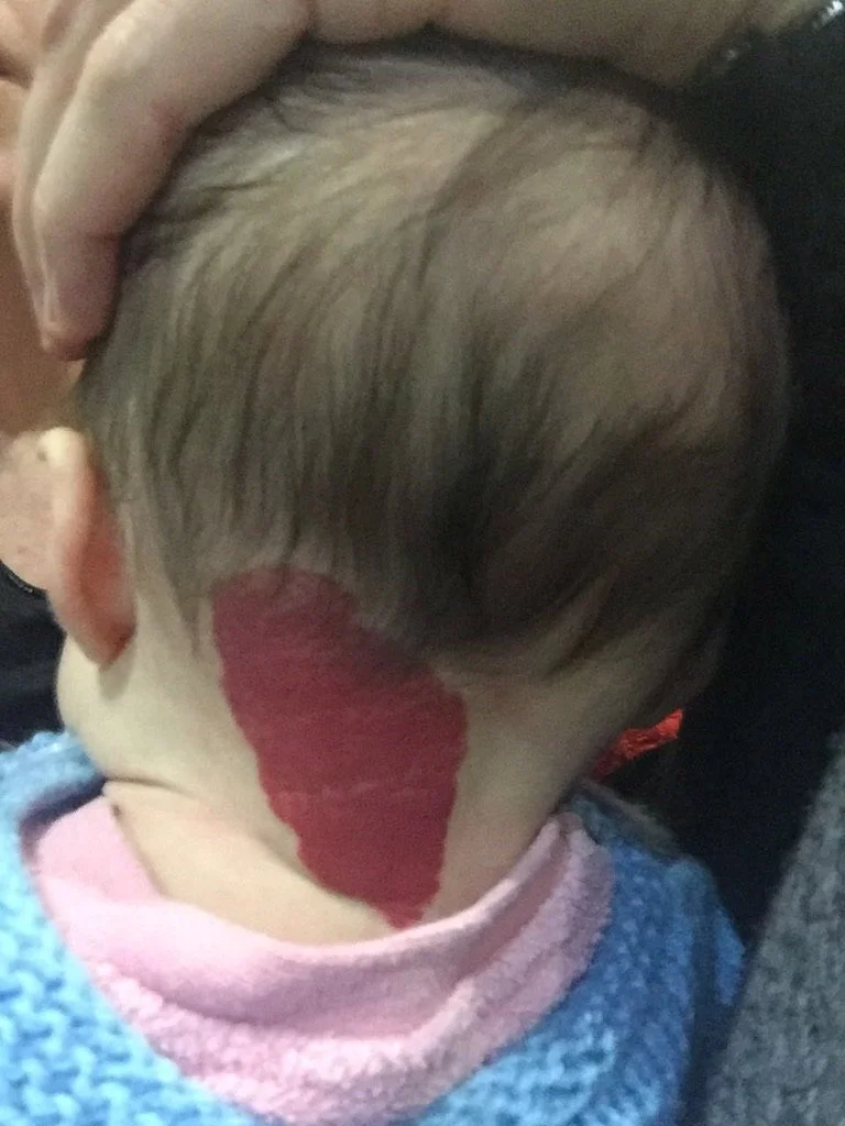 infantile-hemangioma-red.jpeg