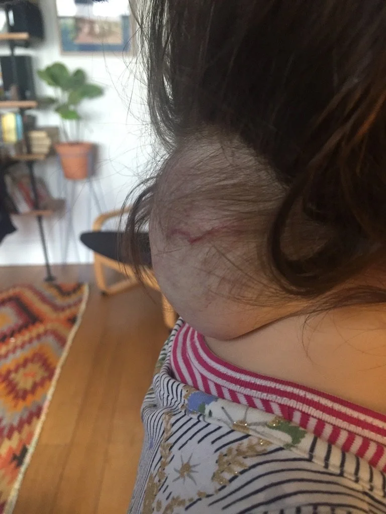 infantile-hemangioma-side.jpeg
