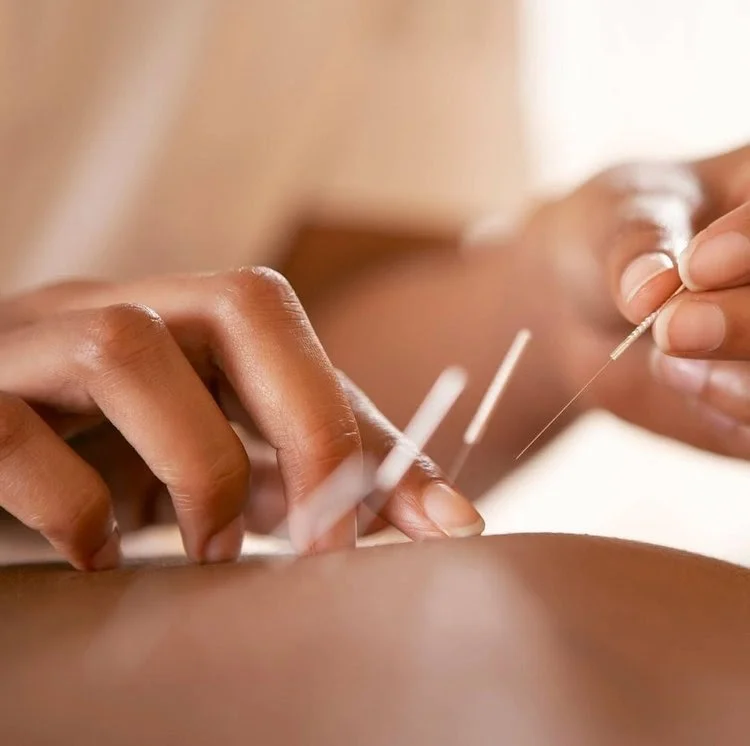 Experience the benefits of acupuncture