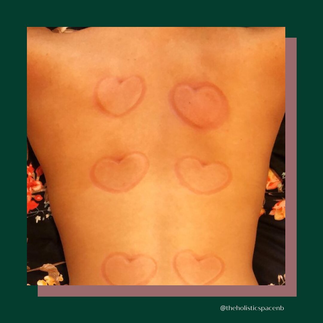 There&rsquo;s more to fire cupping than the interesting marks you&rsquo;ll have on your back! 

&ldquo;Where there&rsquo;s stagnation, there will be pain. Remove the stagnation, and you remove the pain&rdquo; - Chinese Proverb 

Cupping is one of the