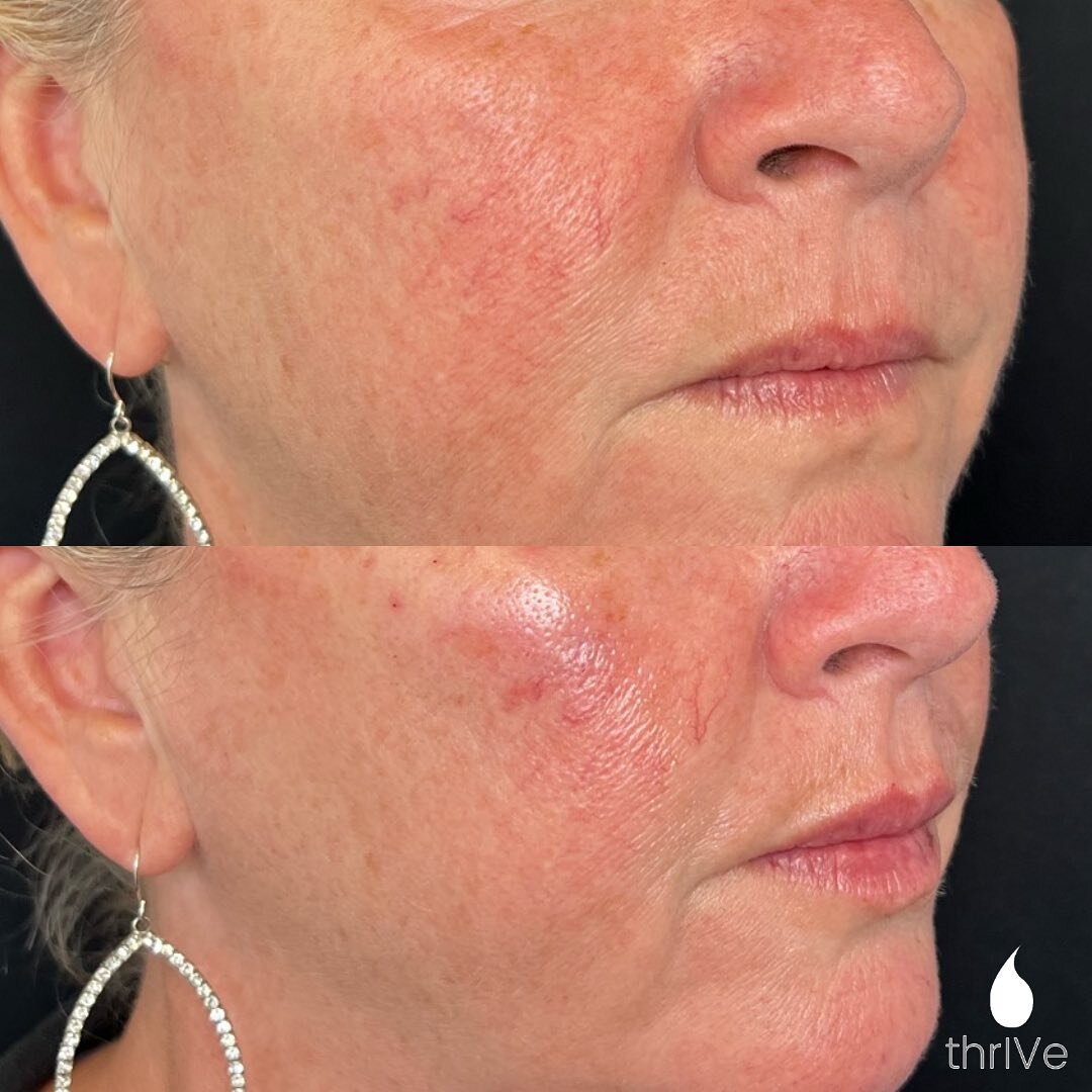 Some Labor Day Cheek filler!🇺🇸🙌&hellip; cheek filler is subtle yet SO impactful to facial sculpting💉

Cheek filler helps stimulate collagen to that area making the skin &amp; contour more youthful or defined! 

Book with the best @thrivebeautyspa