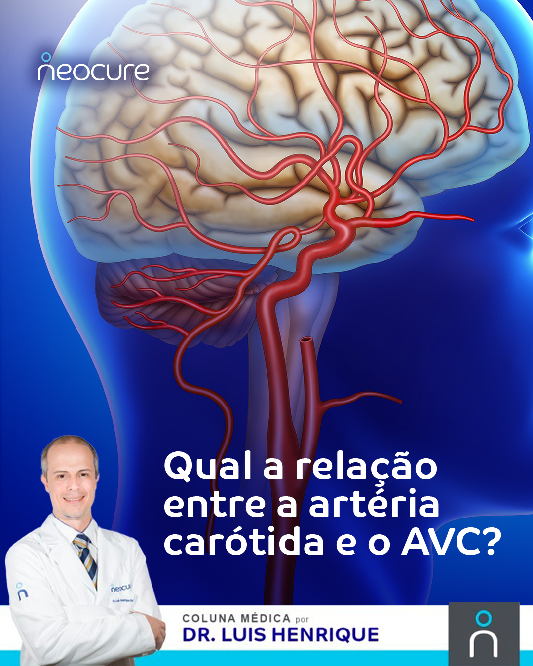 Qual a relação entre a artéria carótida e o AVC?