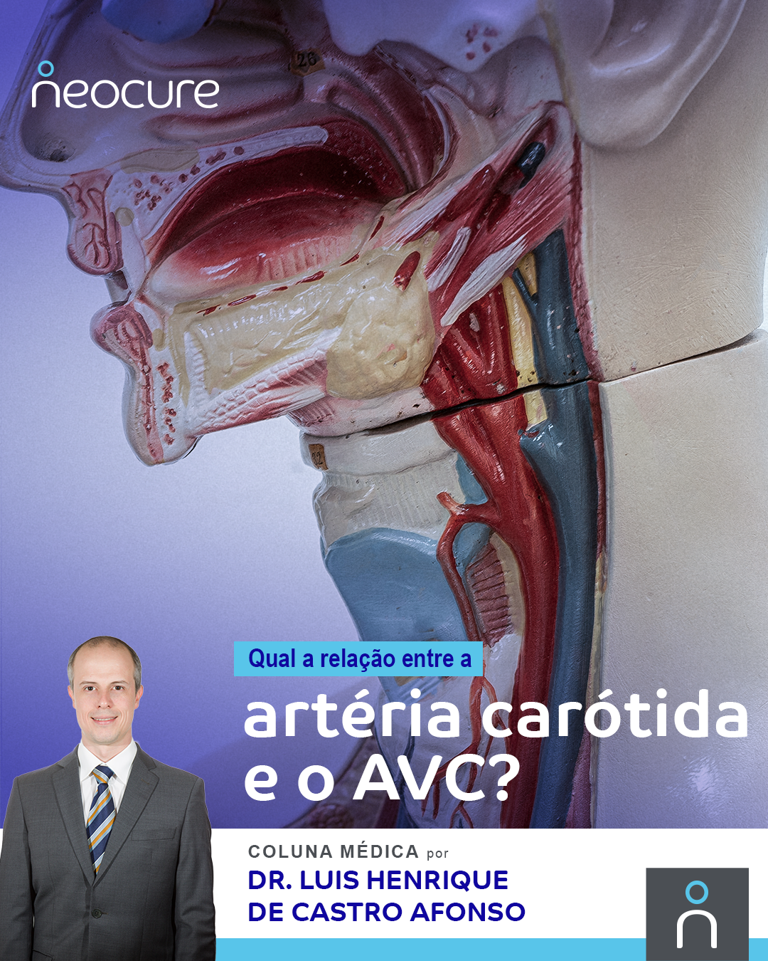 Qual a Relação entre a Artéria Carótida e o AVC?