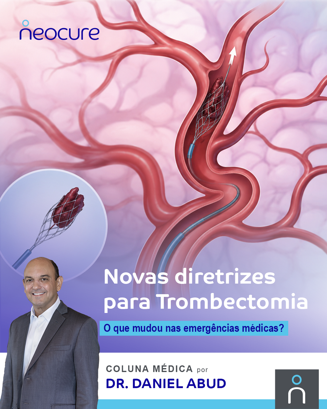 Novas diretrizes para trombectomia: o que mudou nas emergências médicas?