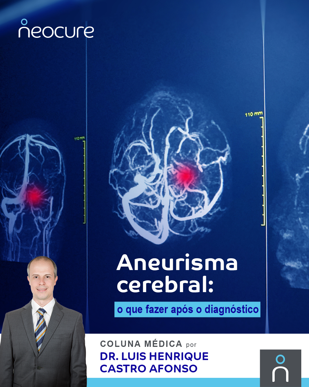 Aneurisma cerebral: o que fazer após o diagnóstico