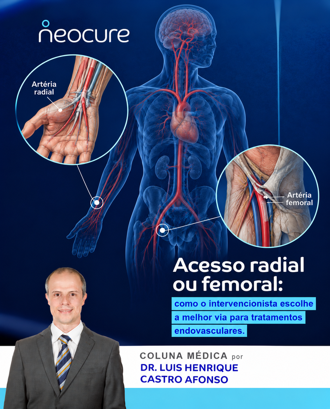 Acesso radial ou femoral: como o intervencionista escolhe a melhor via para tratamentos endovasculares?