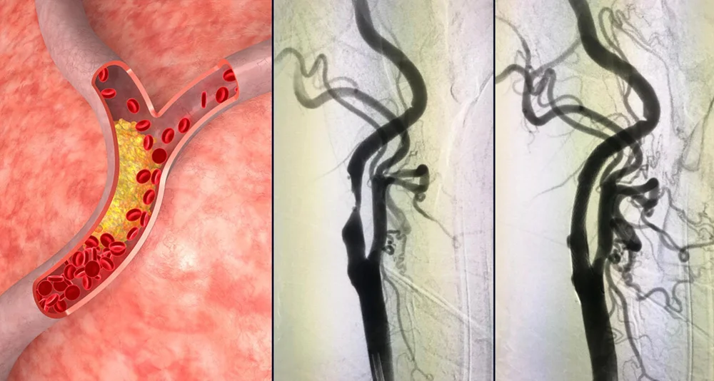 Angioplastia de carótida - como é? — Neocure