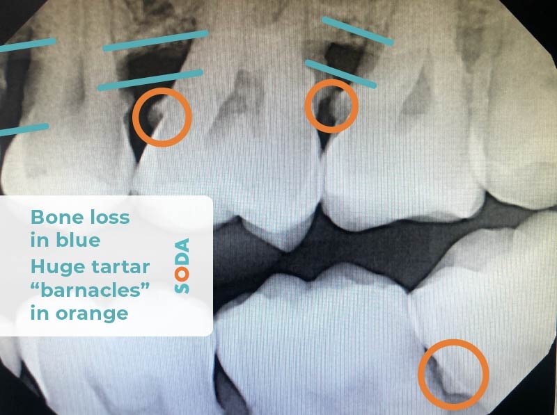 Learn To Read your OWN Dental Xrays! — SODA