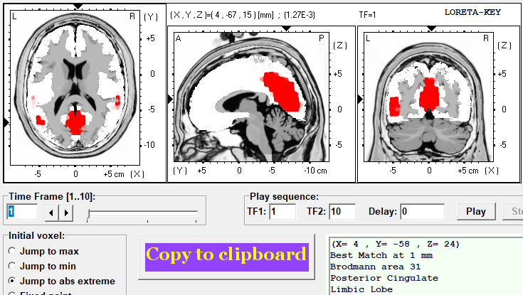 qEEG brain map using LORETA source localization, showing highlighted activity in the posterior cingulate across three brain views