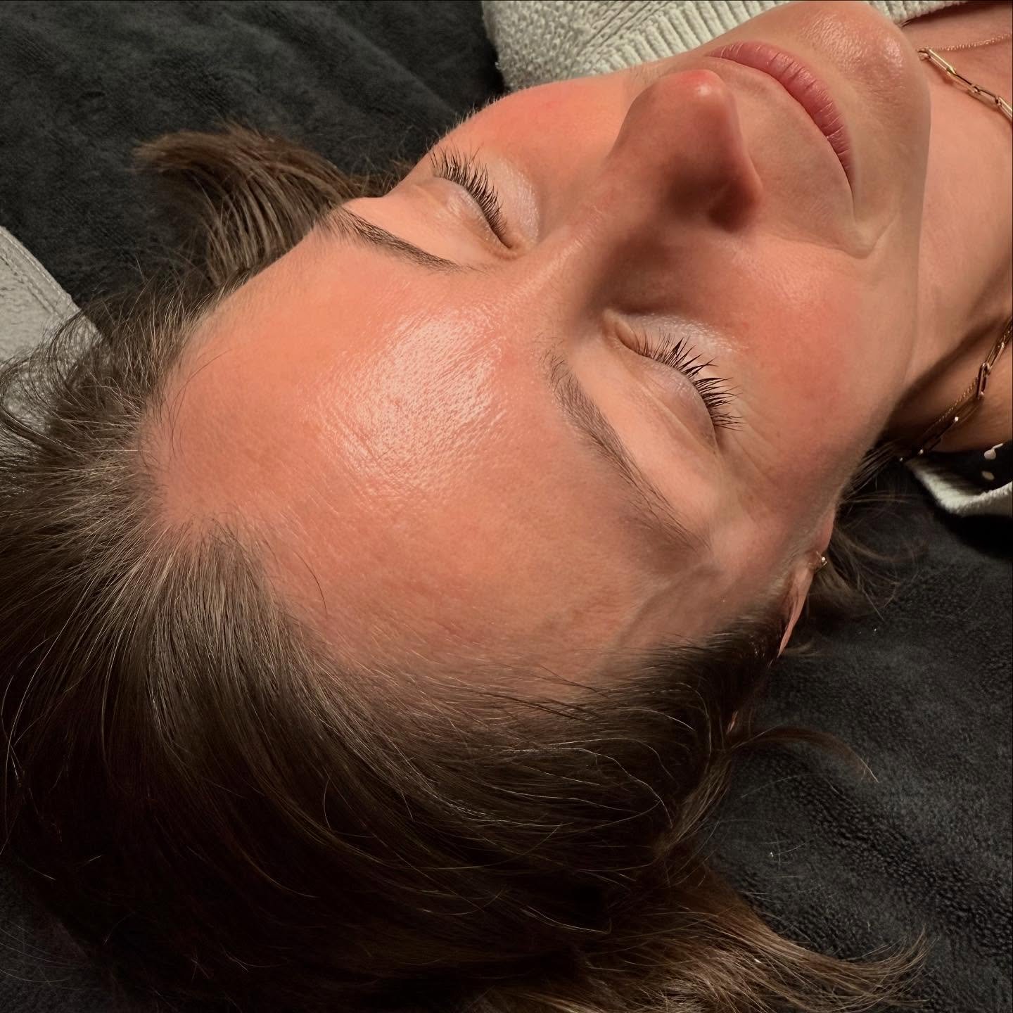 ✨ There&rsquo;s nothing like a Linderhealth peel to kick off summer with a glow! 🌞💆&zwj;♀️ Post-peel pics? Always flawless! 📸✨

💖 No downtime
🔥 Minimizes inflammation
🛡️ Strengthens your skin barrier
🧬 Targets stubborn &ldquo;zombie cells&rdqu