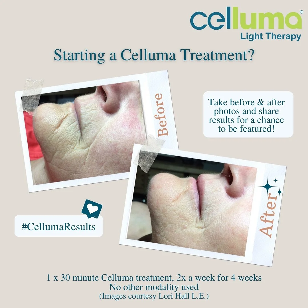 Celluma LED Light Therapy is not just a trend &mdash; it&rsquo;s a true game changer for your skin! 💡

🌟 Benefits include:
💖 Reduces inflammation &amp; redness
🧖&zwj;♀️ Improves acne &amp; breakouts
🕒 Speeds up healing &amp; recovery
💪 Boosts c
