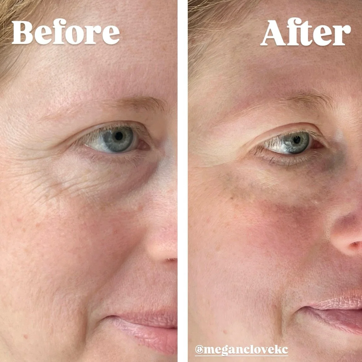 Side-by-side comparison of a woman’s face showing skin before and after skincare treatment; the 'before' side displays wrinkles and uneven skin texture, while the 'after' side shows smoother, clearer skin.