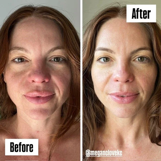 Side-by-side comparison of a woman before and after facial, showing clear skin treatment improvements.
