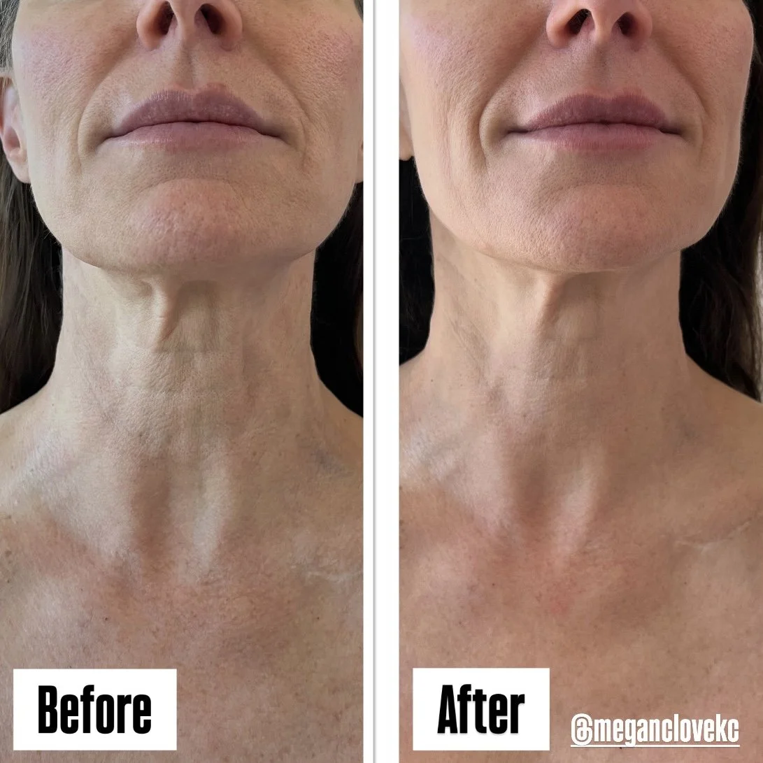 Side-by-side comparison of a woman's neck and lower face showing skin improvement. The left side labeled 'Before' shows skin with wrinkles and uneven texture; the right side labeled 'After' shows smoother skin with fewer wrinkles.