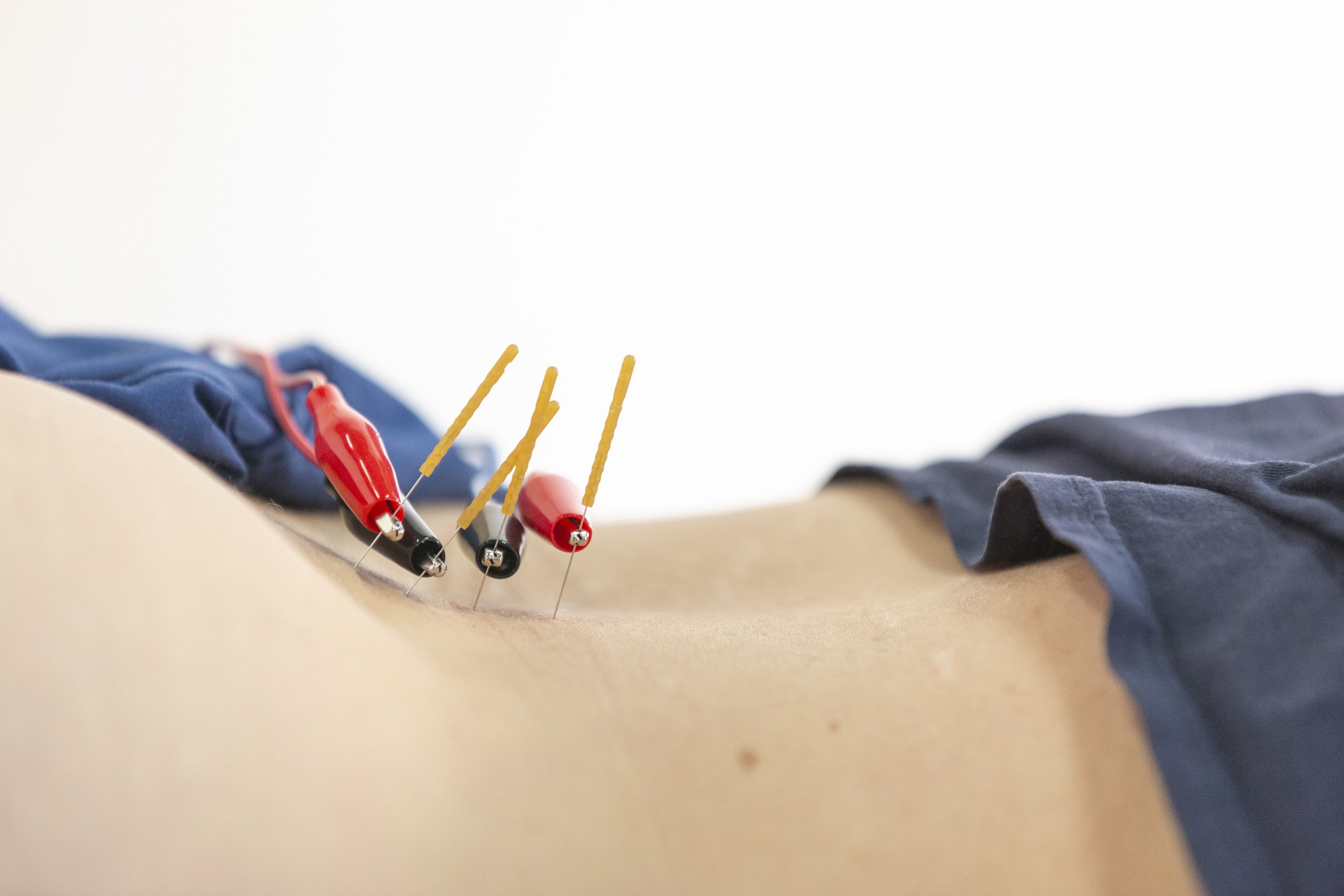 physical therapy Santa Fe dry needling
