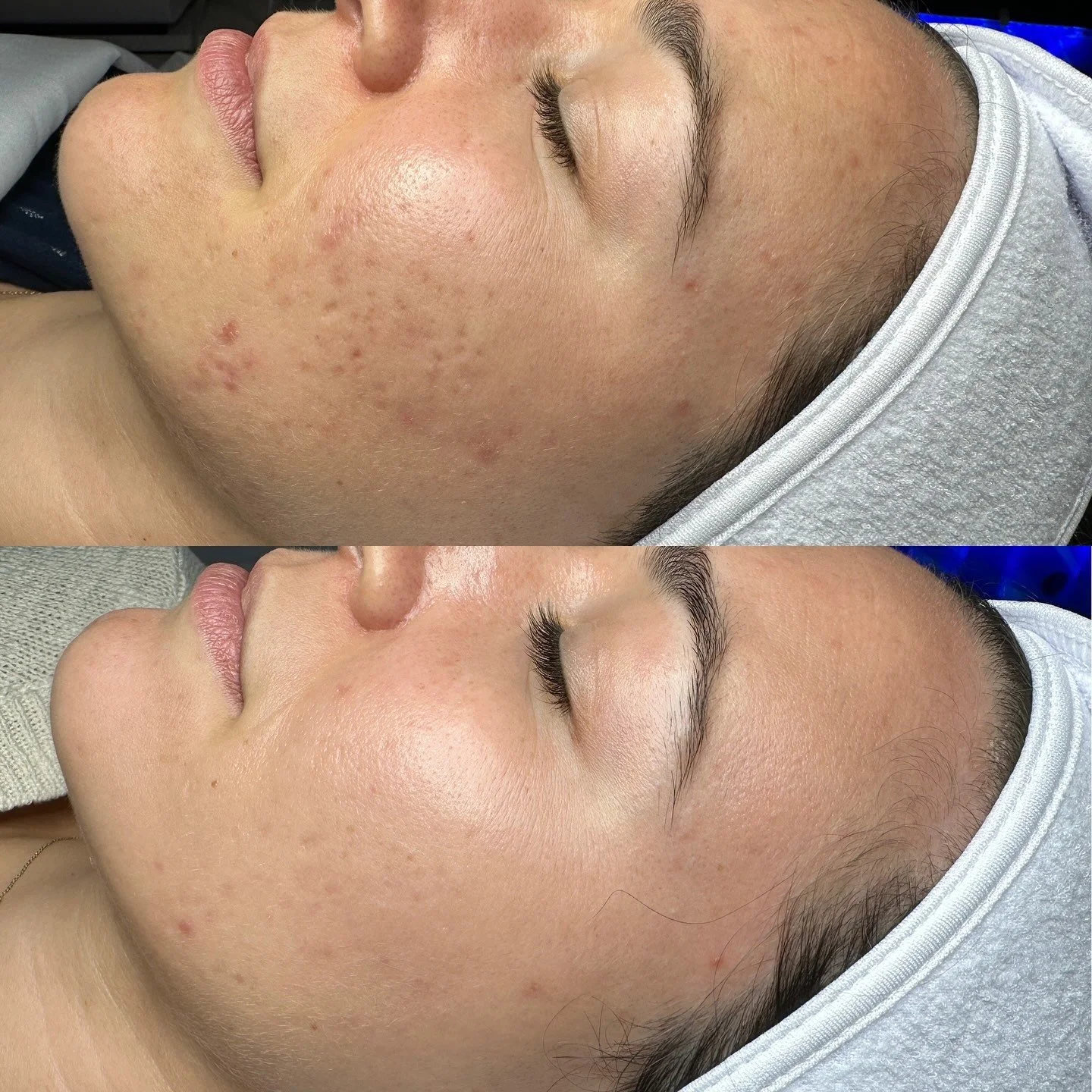 With a little patience, a targeted treatment plan and the right formulas in place, the SKIN has the ability to heal itself in the best way possible.

#skinhealth #scottsdaleskincare #acnebeforeandafter