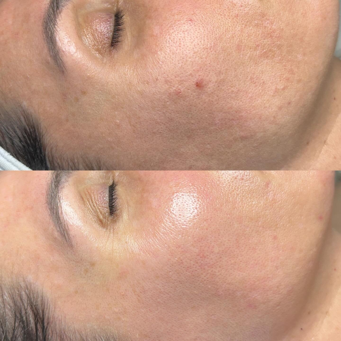A little skin glow-up for this beauty!

Dermaplaning was definitely worth the wait 👏🏼. We focused on healing and strengthening her skin first before introducing any physical exfoliation.

When the skin needs to repair, less really is more. Healthy 