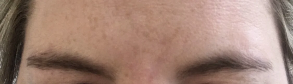 After Dysport® treatment