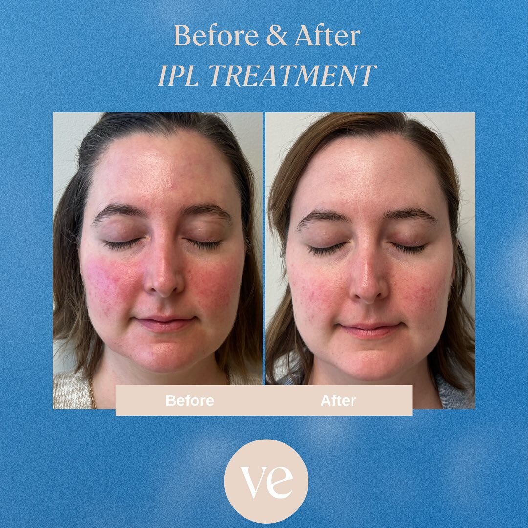 Our lovely client&rsquo;s before and after of 3 sessions of IPL treatments to target rosacea and underlying reds. Typically 2-3 treatments every 4-6 weeks are recommended to see visible results. Contact us today for a consultation or questions about 