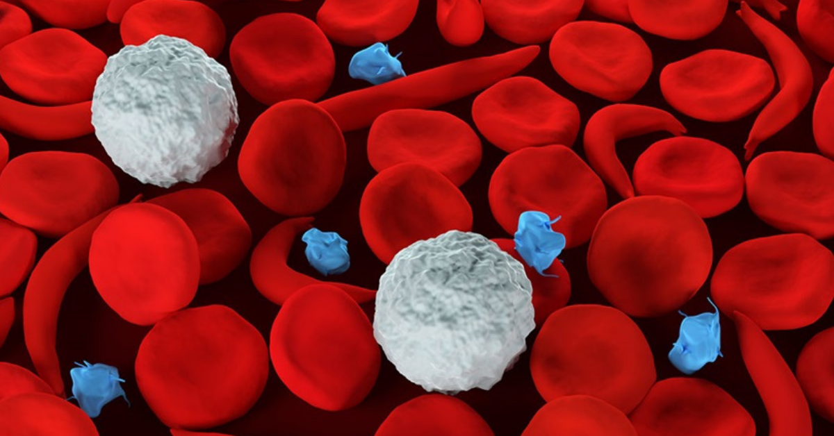 Multinational CASiRe - Will Emerging Tools Harmonize Treatment for Sickle Cell Disease Patients?