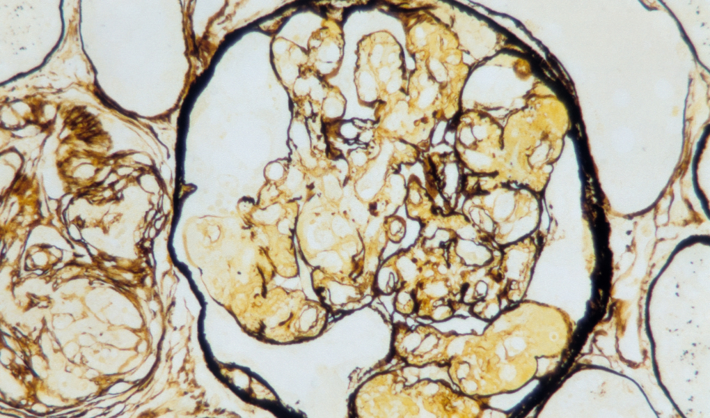 What Causes Long-Haul COVID-19 and POTS_.png