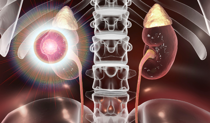 Renal Cell Carcinoma vs Renal Medullary Carcinoma Explained