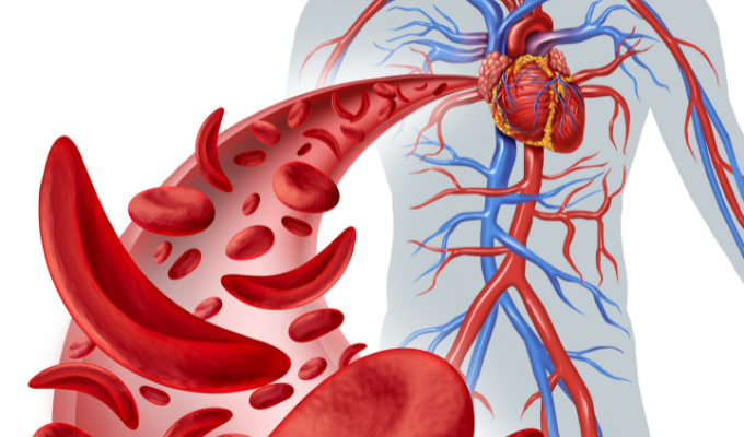 Sickle Cell Disease vs Sickle Cell Trait, What’s the Difference?