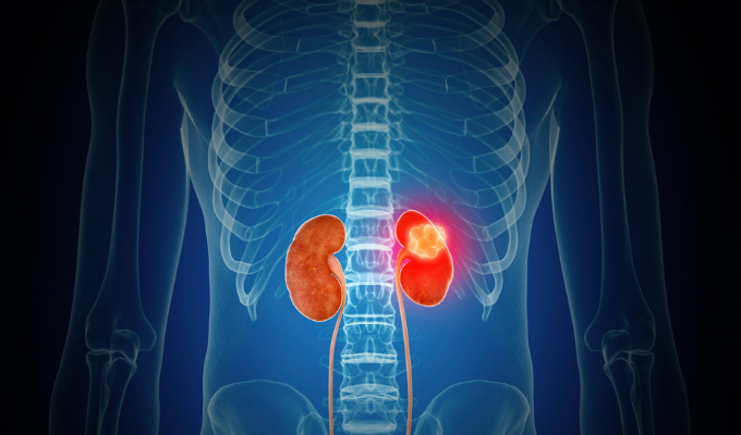How Is Kidney Cancer Diagnosed?