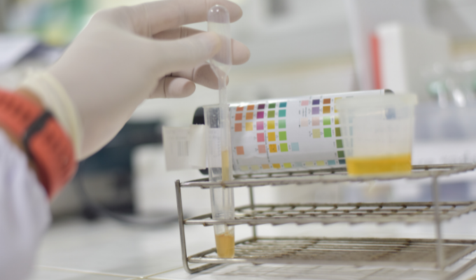 What Is the Importance of a Urinalysis?
