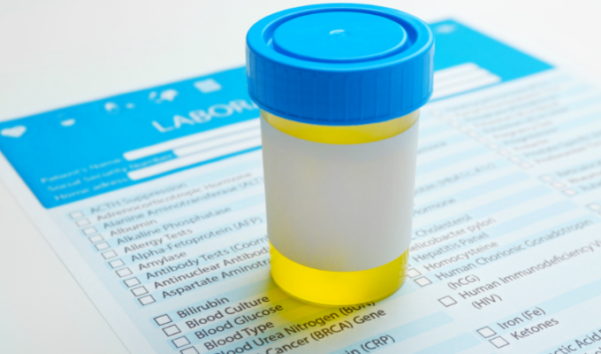 What Urinalysis Tests Are Used to Check for Various Illnesses?