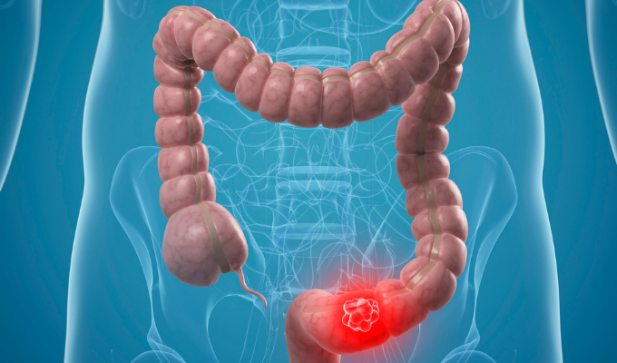 What Are Known Risk Factors of Colorectal Cancer?