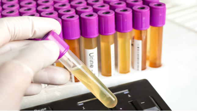 Improving Kidney Health | A Breakthrough in Urine Testing