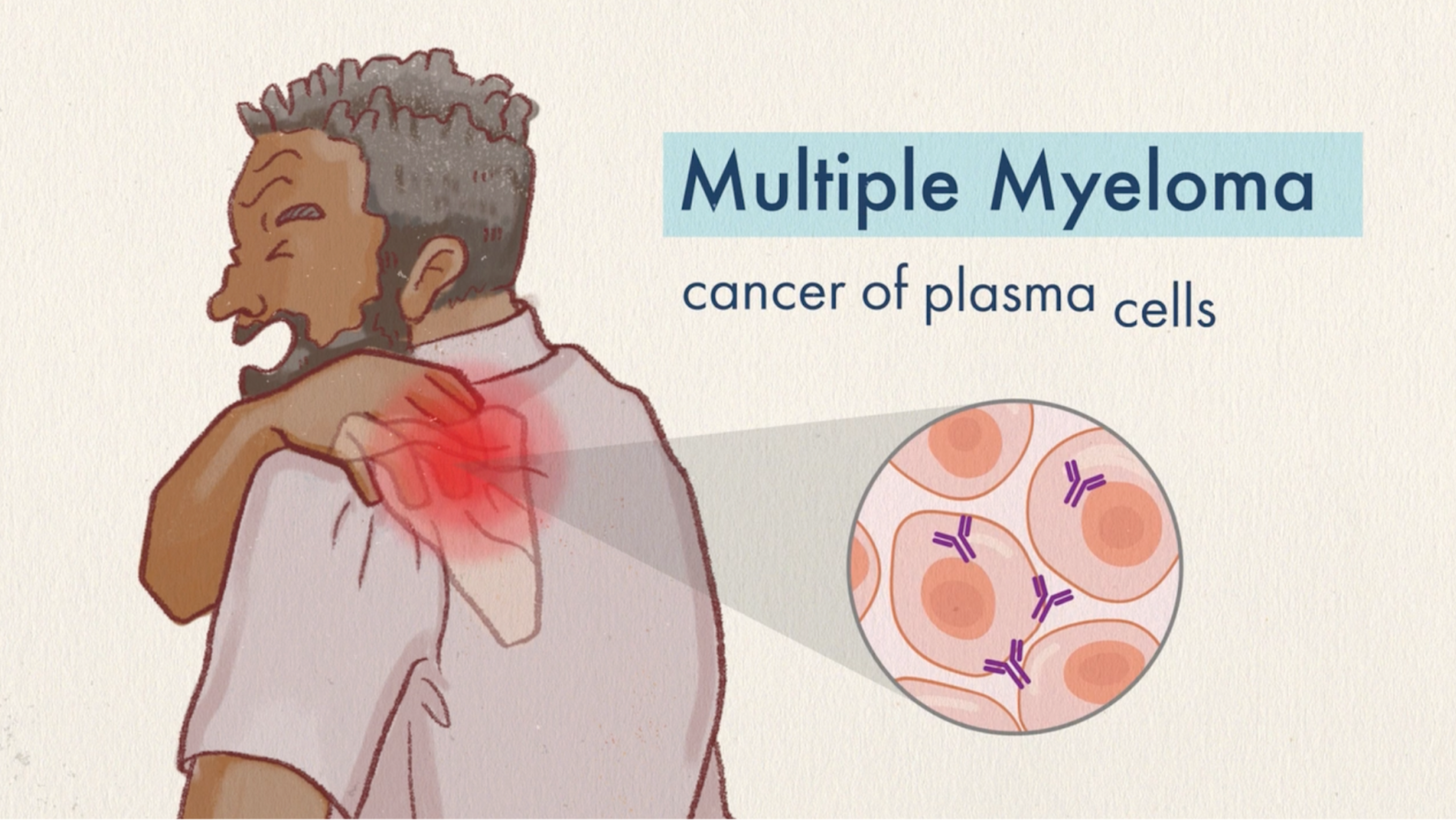 multiple myeloma explainer video