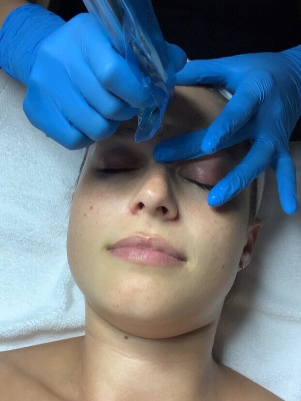All you need to know about Micro-Needling
