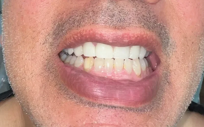 After photo — natural-looking replacement veneers by Dr. Jennifer Ebner, Phoenix AZ. New ceramic veneers with a slight shade boost for a naturally healthy looking smile. 