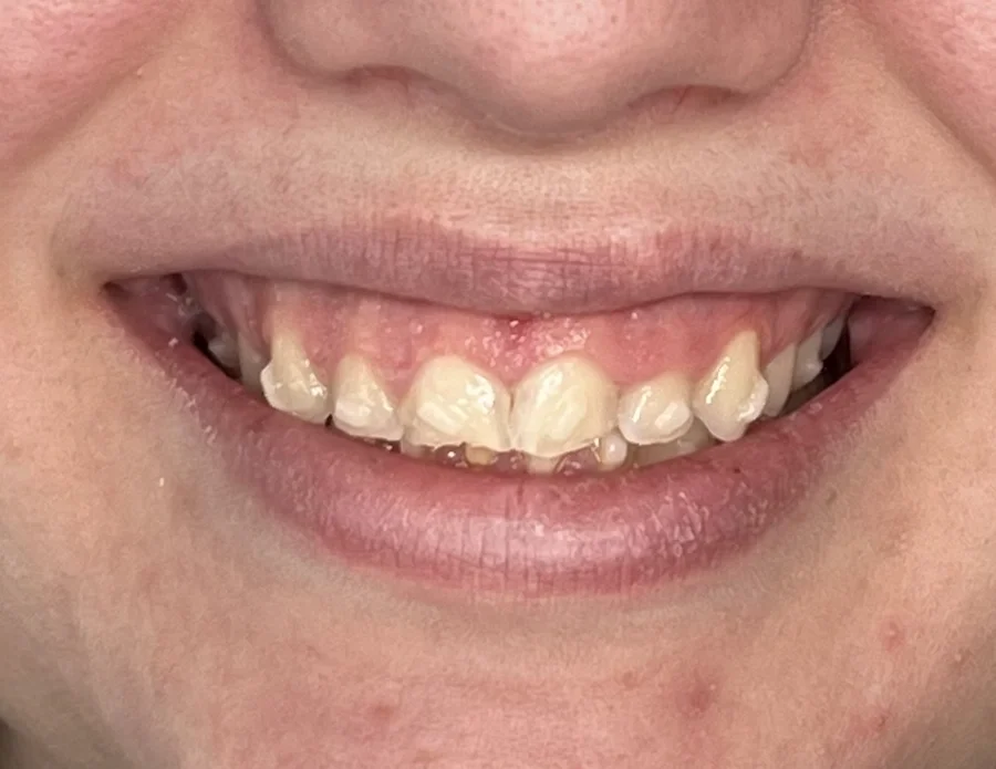 Before photo — gummy smile correction candidate, Dr. Ebner cosmetic dentist Phoenix