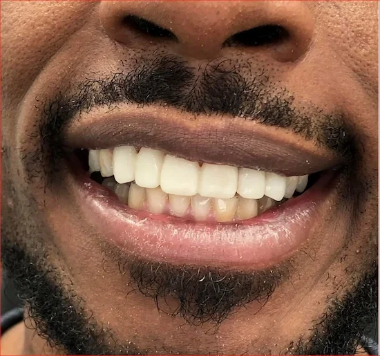 After Photo-  Multiple procedures working in harmony: whitening to set the baseline brightness, veneers to perfect the front teeth, crowns to restore the back teeth, and a bridge to fill the missing gap, all coordinated in a single treatment plan for
