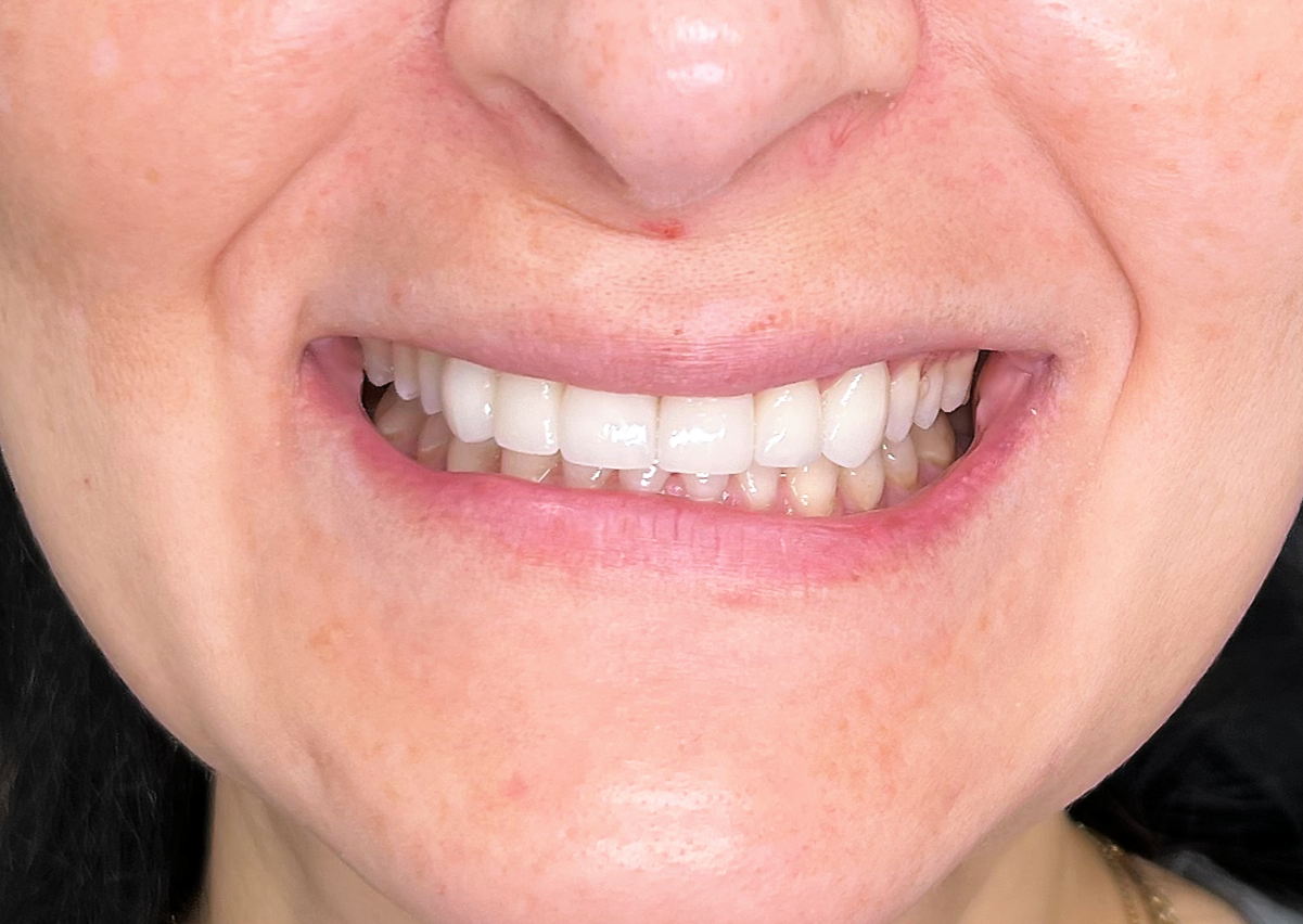 white porcelain dental veneers on six teeth phoenix dental office
