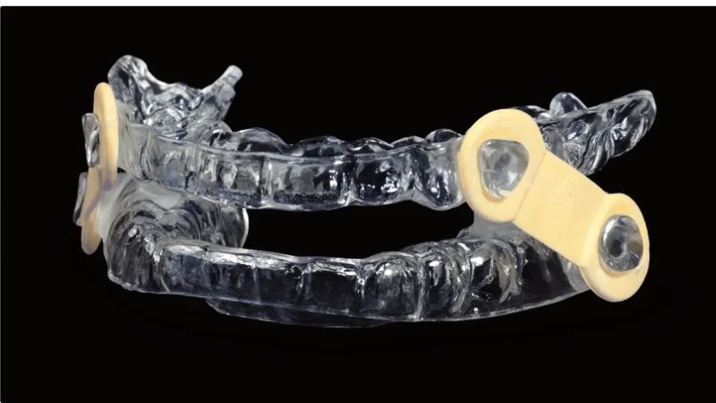 Sleep Apnea Oral Appliance Phoenix | CPAP Alternative | Innovative Dentistry Biltmore