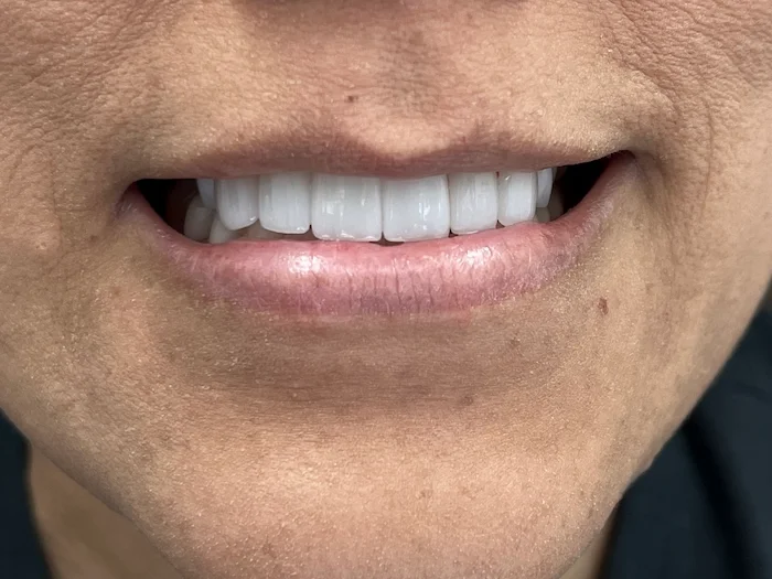 After photo — natural-looking dental bridge replacement by Dr. Ebner, Phoenix AZ