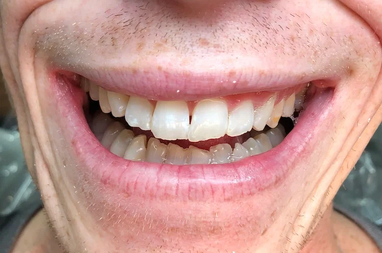 Before photo — worn and discolored teeth, candidate for porcelain veneers Phoenix. Worn, dark and broken teeth effected this man's confidence. This photo is after Invisalign with Dr. Ebner.