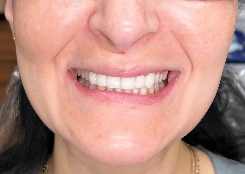 Years of wear and discoloration had taken the brightness from this patient's smile. Dr. Ebner designed a set of ten custom porcelain veneers that restored natural color, shape, and symmetry — without looking overdone or artificial.
Procedure: Porcela