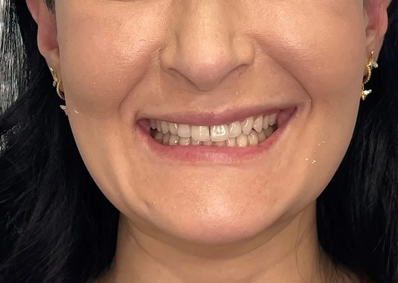 The two front teeth always bothered this woman. She had older crowns that were crooked and gapped. She did not want her teeth to look fake or too white.