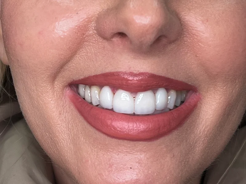 Porcelain veneer result by Dr. Jennifer Ebner, cosmetic dentist at Innovative Dentistry Biltmore, Phoenix AZ