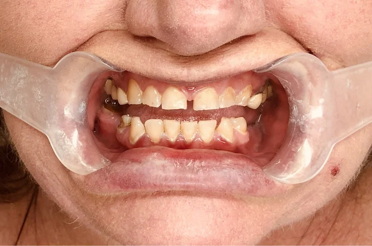 Before photo — severe dental decay from dental phobia and trauma, full mouth reconstruction candidate