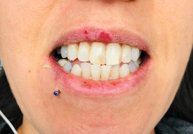 Larger fillings on front teeth that were stained. Teeth were crooked but the woman did not want braces.