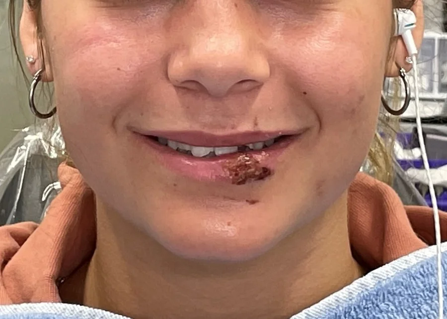 Before Photo- Traumatic fracture of front teeth. After an accident that broke this young woman's front teeth off, ceramic crowns were planned.