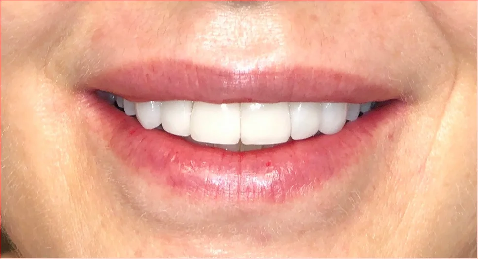 After photo — Years of coffee and red wine had darkened and worn this patient's teeth beyond what whitening alone could correct. No-prep Lumineers, placed without drilling or shots, restored brightness and shape while preserving 100% of the natural t