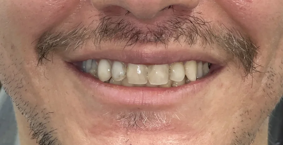 Before photo — discolored teeth before bleaching, veneers, crowns and bridge, Phoenix AZ Staining and decay under dental bonding affected this young man's confidence.